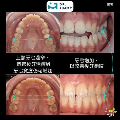 嘴巴閉起來牙齒|【新竹品味牙醫】口呼吸？嘴巴關不起來？MRC 把握。